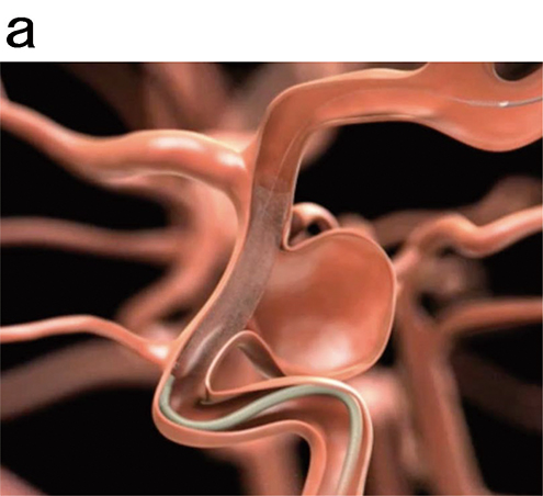 最新ステントを脳動脈瘤がある入れておくと（図a,b）脳動脈瘤への血流が抑えられ自然に脳動脈瘤が消滅する（図ｃ→ｄ）