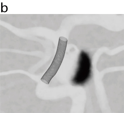 最新ステントを脳動脈瘤がある入れておくと（図a,b）脳動脈瘤への血流が抑えられ自然に脳動脈瘤が消滅する（図ｃ→ｄ）