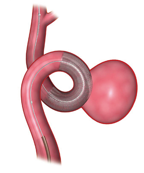 脳神経外科領域で2015年10月より国内でも治療開始された、カテーテル治療で使われる最新ステント「フローダイバーター」