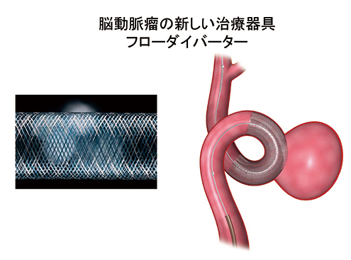 脳神経外科領域で2015年10月より国内でも治療開始された、カテーテル治療で使われる最新ステント「フローダイバーター」