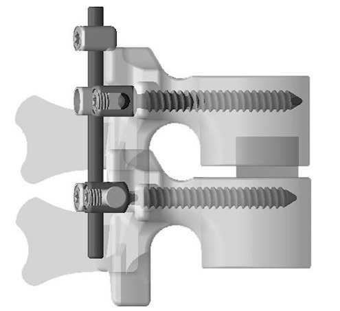 日赤式脊椎制動術：ネジとロッドの間に動きが許容されており、変形が生じにくい